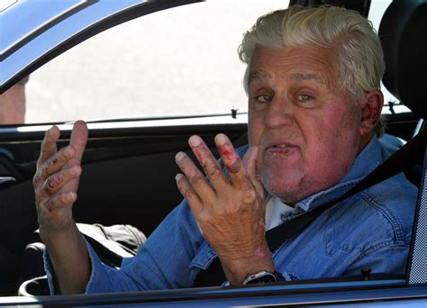 jay leno|jay leno burned in car accident.